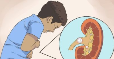 7 dấu hiệu cho thấy thận có sỏi, ảnh hưởng nghiêm trọng đến sức khỏe