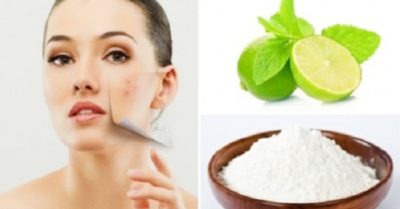 4 công thức trị mụn và làm sáng da bằng baking soda rất hiệu quả