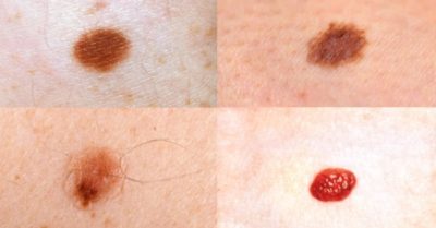 Mọc nốt ruồi ở 4 vị trí này cần lưu ý, dễ hình thành khối u ác tính bất cứ lúc nào