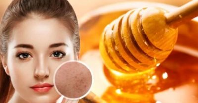 Bật mí 5 cách trị mụn ẩn dưới da tại nhà từ nguyên liệu thiên nhiên