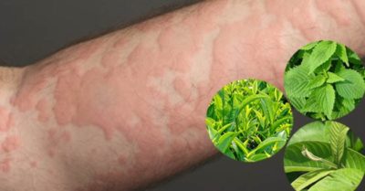 9 loại lá dân gian giúp chữa trị chứng mề đay, mẩn ngứa và dị ứng rất hiệu quả