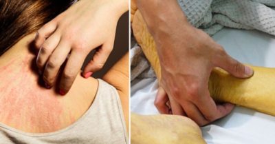 Những dấu hiệu trên cơ thể cho thấy mắc bệnh ung thư tuyến tụy, cần đi khám sớm