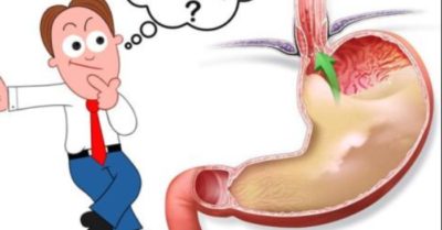 7 cách giảm trào ngược dạ dày thực quản nhanh chóng mà không cần dùng thuốc