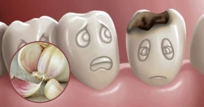 4 cách chữa đau răng nhanh chóng, hiệu quả tại nhà chỉ với 1 củ tỏi