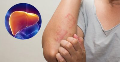 2 vị trí bị ngứa trên cơ thể cảnh báo gan đang có vấn đề, không nên chủ quan
