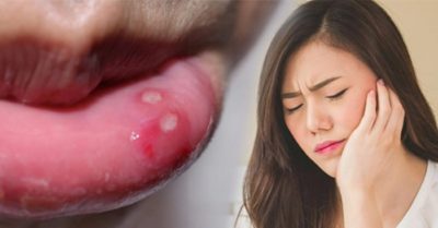 9 cách chữa nhiệt miệng hiệu quả tại nhà mà không cần dùng thuốc