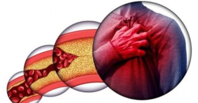 Những dấu hiệu cảnh báo mỡ máu tăng cao, cần phát hiện kịp thời