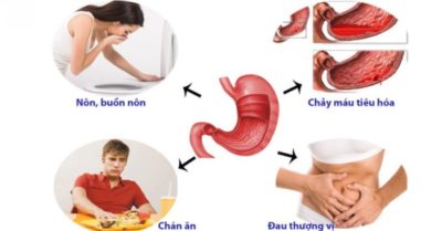 Những dấu hiệu nguy hiểm bất thường khi đau dạ dày, cần chữa trị kịp thời