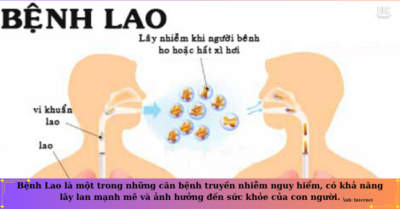 Bệnh Lao – Bệnh truyền nhiễm nguy hiểm