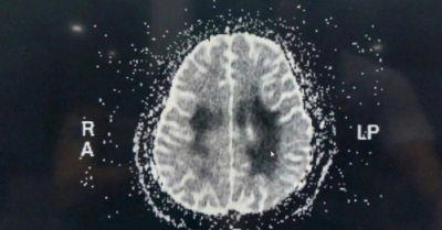 Tác hại của thuốc lá điện tử thụ động khiến nữ sinh tổn thương não