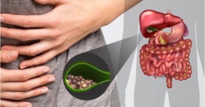Sỏi mật gây biến chứng viêm tụy cấp nguy hiểm