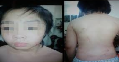 Bé trai Hà Nội nghi bị mẹ kế bạo hành