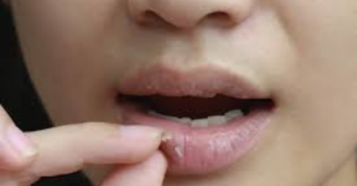 Mẹo trị môi khô nứt nẻ mùa Thu