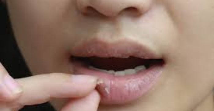 Mẹo trị môi khô nứt nẻ mùa Thu