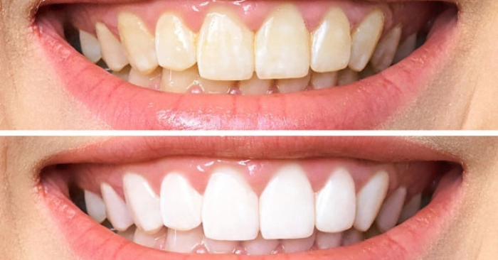 Mẹo Tự Chế Giúp Răng Trắng Sáng Tự Nhiên