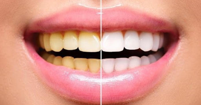 Mẹo Tự Chế Giúp Răng Trắng Sáng Tự Nhiên