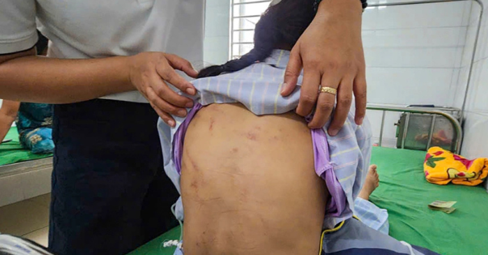 Bạo hành trẻ em: Bé lớp 5 bị cha dượng đánh bằng búa đinh