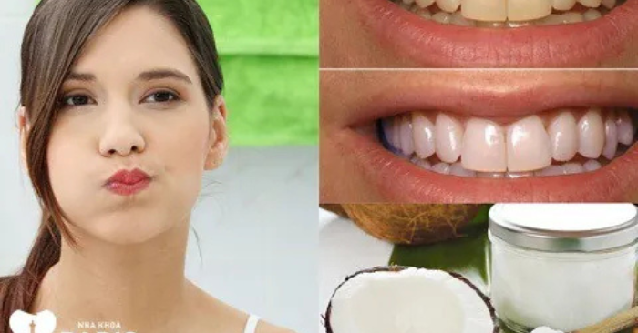 Súc miệng bằng dầu dừa và 3 lợi ích đáng kinh ngạc