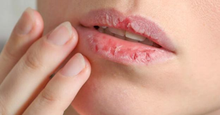 Cách trị môi khô nứt nẻ tại nhà