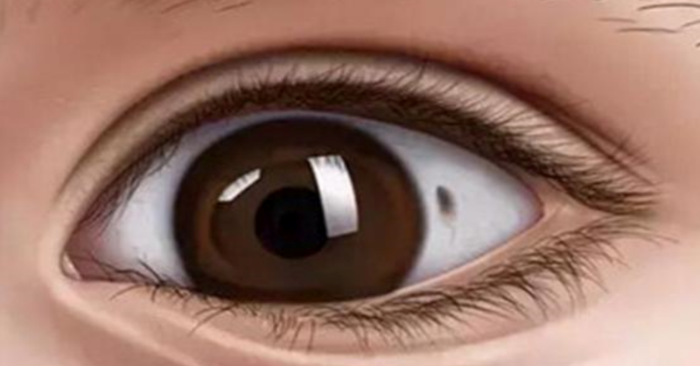 Khi mắt nhìn thấy đốm đen