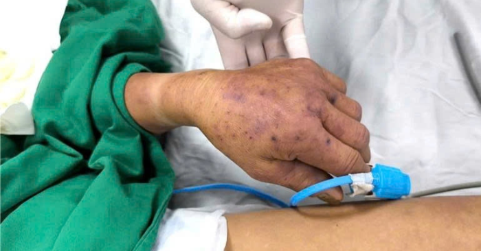 Bệnh nhân đang được điều trị tích cực do nhiễm liên cầu lợn sau khi ăn tiết canh