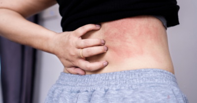 Ngứa da cảnh báo thận không khỏe