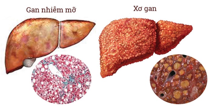 Giảm gan nhiễm mỡ hiệu quả nhờ các bài tập đơn giản; giúp cải thiện chức năng gan, hỗ trợ kiểm soát cân nặng và tăng cường sức khỏe toàn diện mỗi ngày