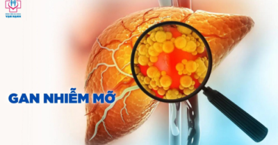 Giảm gan nhiễm mỡ bằng các bài tập phù hợp