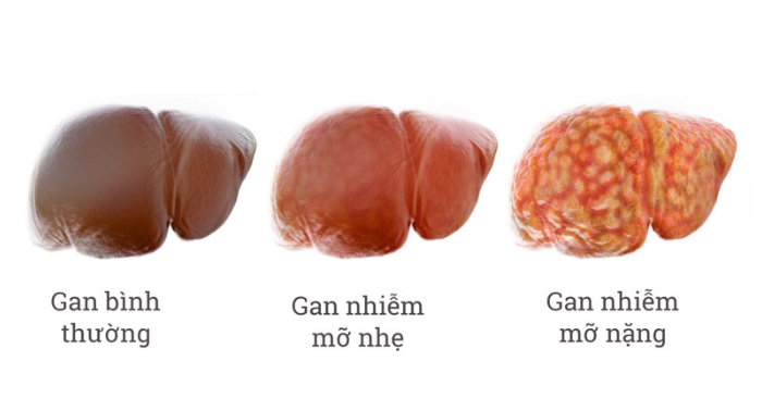 Nghịch lý người gầy vẫn mắc gan nhiễm mỡ