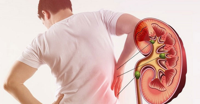 Bốn bệnh lý âm thầm gây hại thận