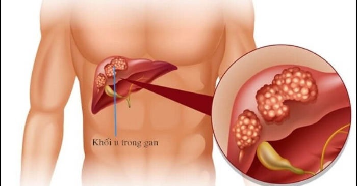 Ung thư gan tăng mạnh mùa lạnh