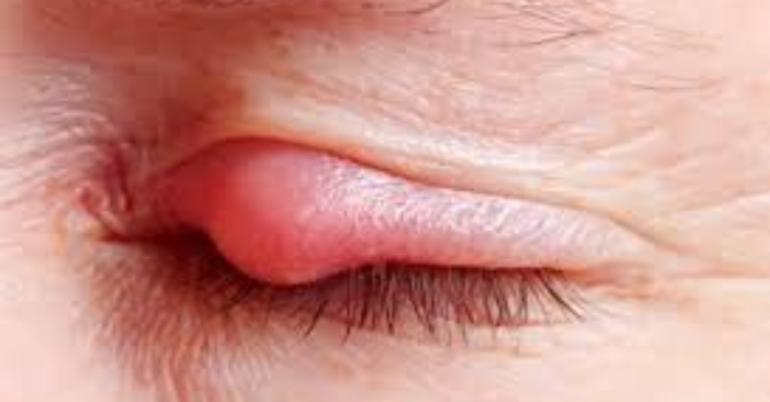 Nhiễm trùng mắt Có lây nhiễm không?