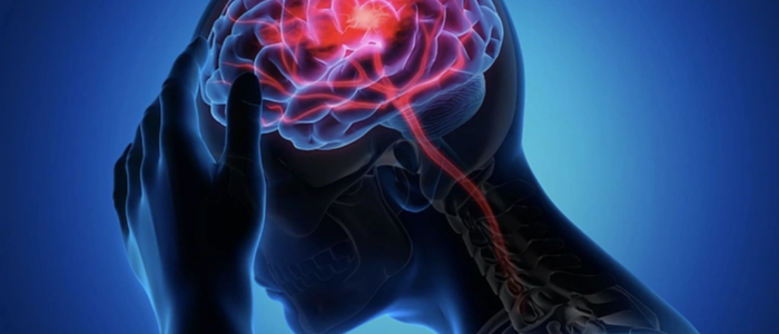 Đột quỵ: Ba thời điểm dễ gây nguy hiểm nhất trong ngày