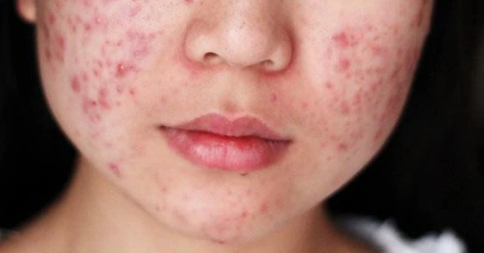 Dấu hiệu cảnh báo bệnh gan đã vào giai đoạn nặng