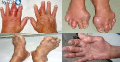 5 bệnh làm tăng acid uric, cần lưu ý
