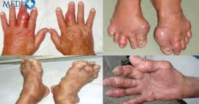 5 bệnh làm tăng acid uric cần lưu ý