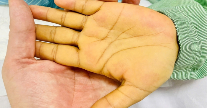 Ung thư gan: Dấu hiệu sớm trước khi đau hay vàng da
