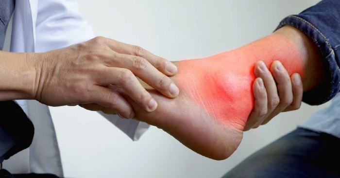 điều trị bệnh gút