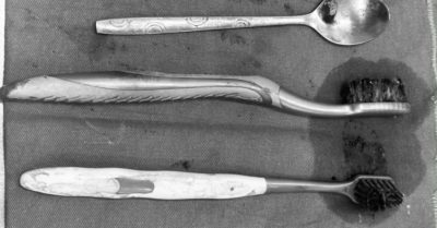 Bệnh viện Việt Đức mổ lấy hai bàn chải và thìa inox trong dạ dày người tự kỷ