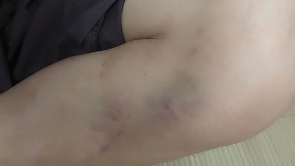 Vụ bạo hành trẻ tại chùa Bầu, Phú Thọ khiến 5 cháu được đưa đi kiểm tra, giám định thương tích. Nhiều cháu có vết bầm tím.