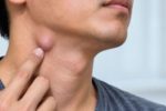 4 biểu hiện ở hạch cổ không nên chủ quan