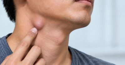 4 biểu hiện ở hạch cổ không nên chủ quan