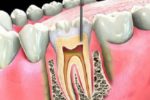 Viêm quanh răng âm thầm, có thể dẫn đến mất răng