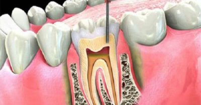 Viêm quanh răng âm thầm, có thể dẫn đến mất răng