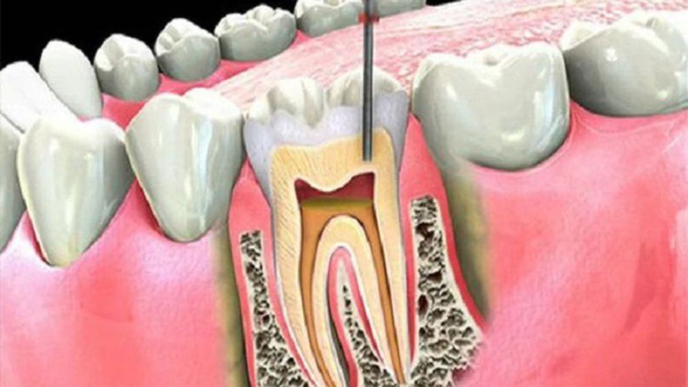 Viêm quanh răng có thể tiến triển âm thầm, gây tiêu xương ổ răng, răng lung lay và tăng nguy cơ mất răng. Nhận biết sớm để điều trị.